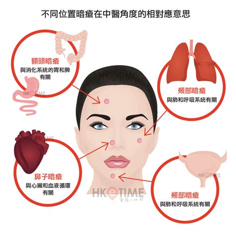 肚皮生瘡|中醫話你知 暗瘡在不同位置代表甚麼？